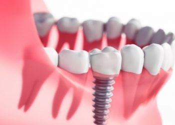 All-on-four dental Implants