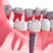 All-on-four dental Implants