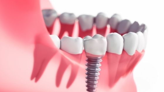 All-on-four dental Implants