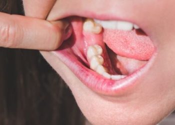 tooth root amputation